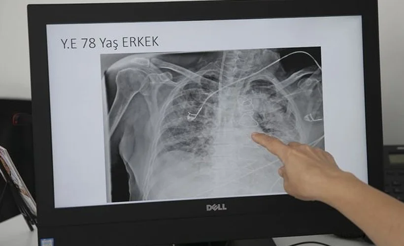 Koronavirüsün akciğerde bıraktığı ağır tahribat görüntülendi