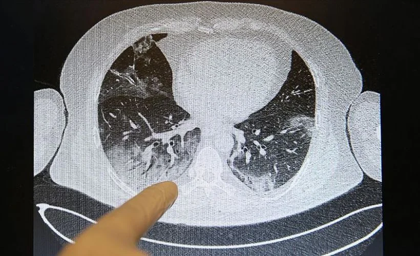 Kovid-19'un akciğerlere verdiği zarar tomografi görüntülerine yansıyor