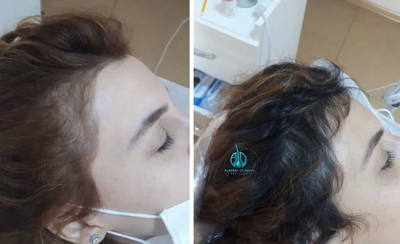 Saç Uzmanı Trikolog Aytekin Quliyeva Saç problemlerinin sırlarını anlattı