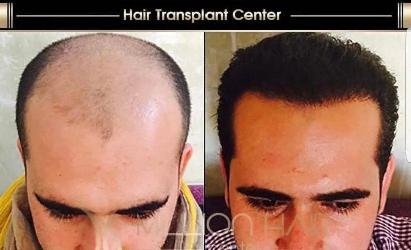 Million Hair Center Markasının CEO'su Fatih Köse: Saç ve Sakal Ekiminde Yeni Yöntemler Deniyoruz