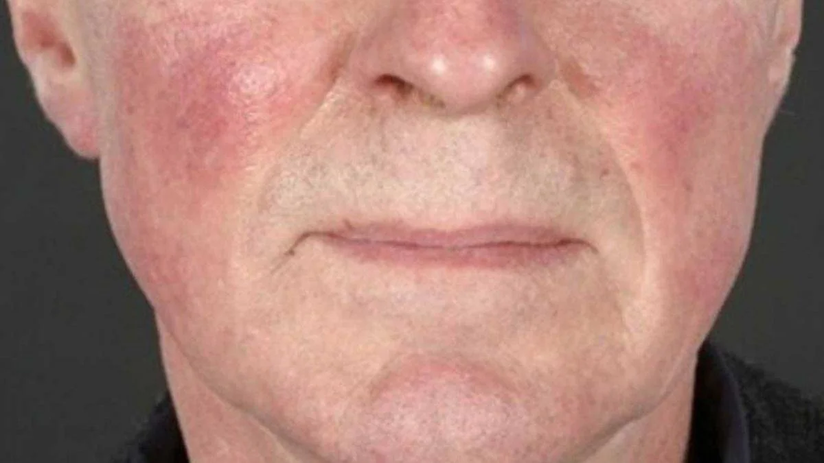 Maske kullanımı sonrası deri egzamasında artış