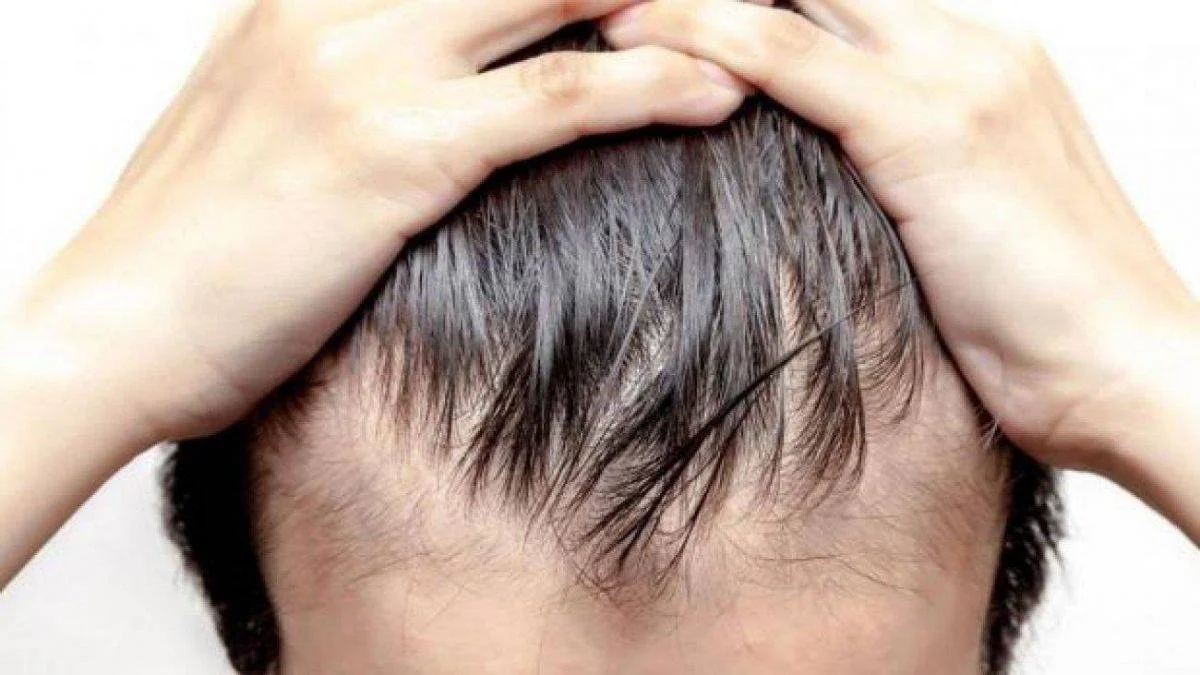 Saç dökülmesi nedir? Saç dökülmesine en iyi çözüm nedir?