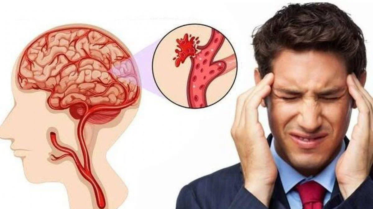 Beyin kanaması nedir? Beyin kanamasının belirtileri nelerdir?