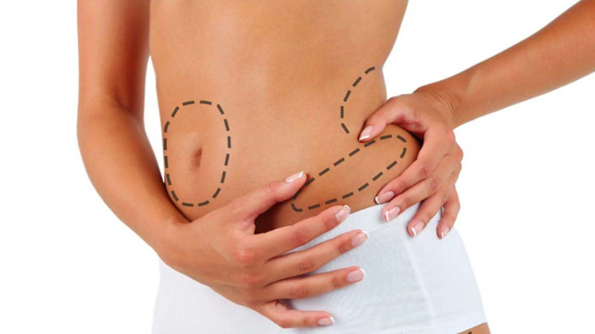 Liposuction ile Vücut Estetiği
