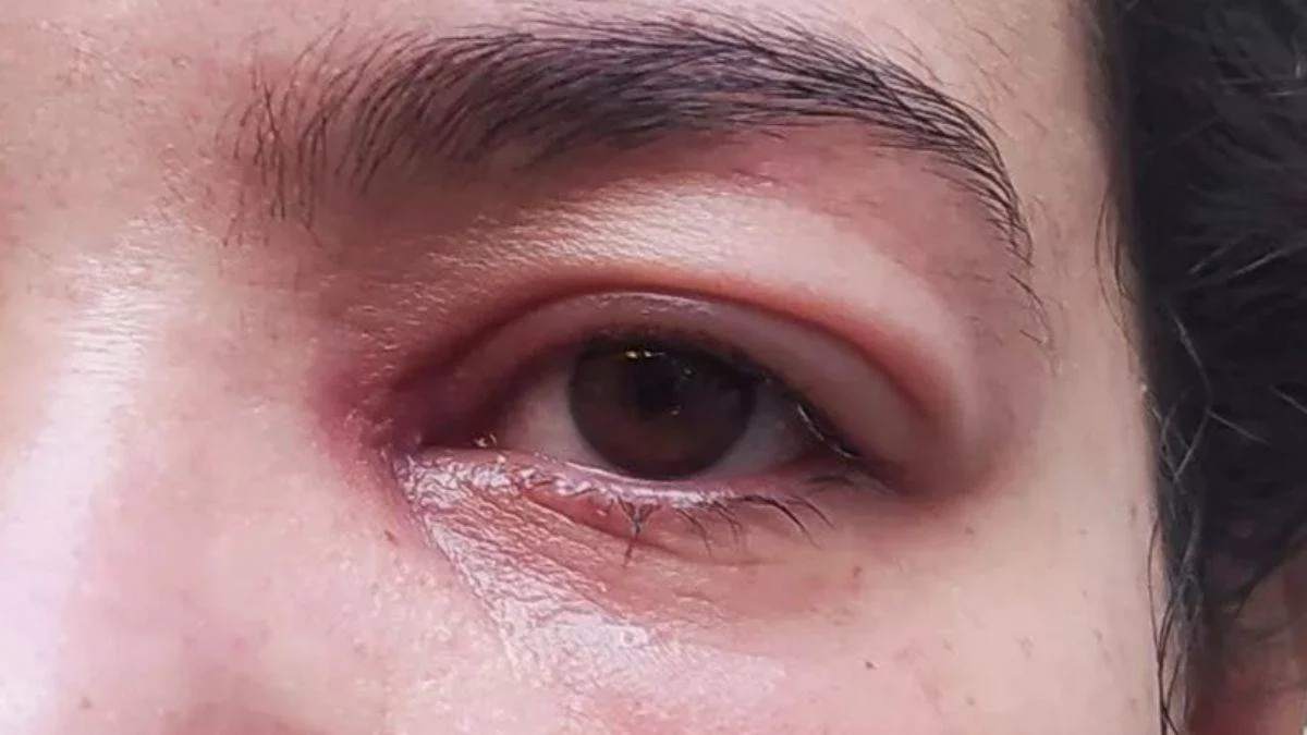 Myastenia gravis nedir?