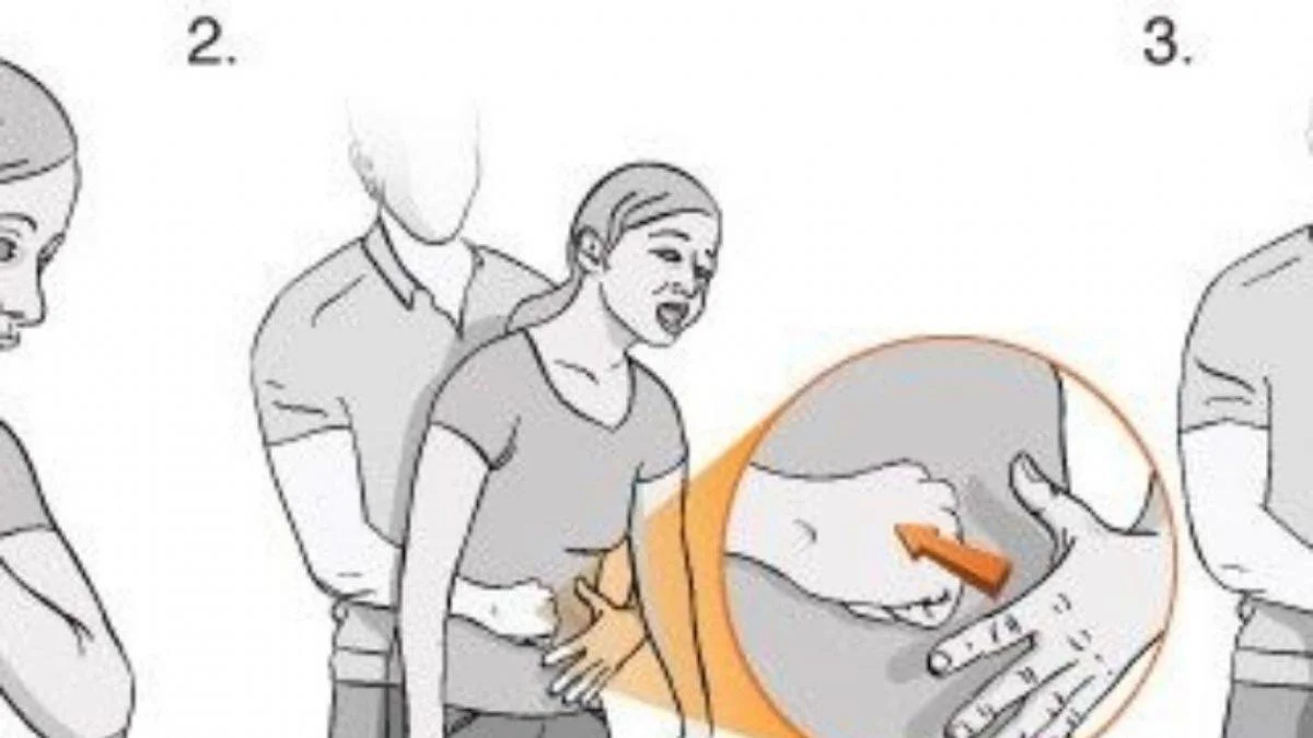 Heimlich Manevrası nedir? Heimlich Manevrası nasıl uygulanır? İşte tüm bilinmesi gerekenler...