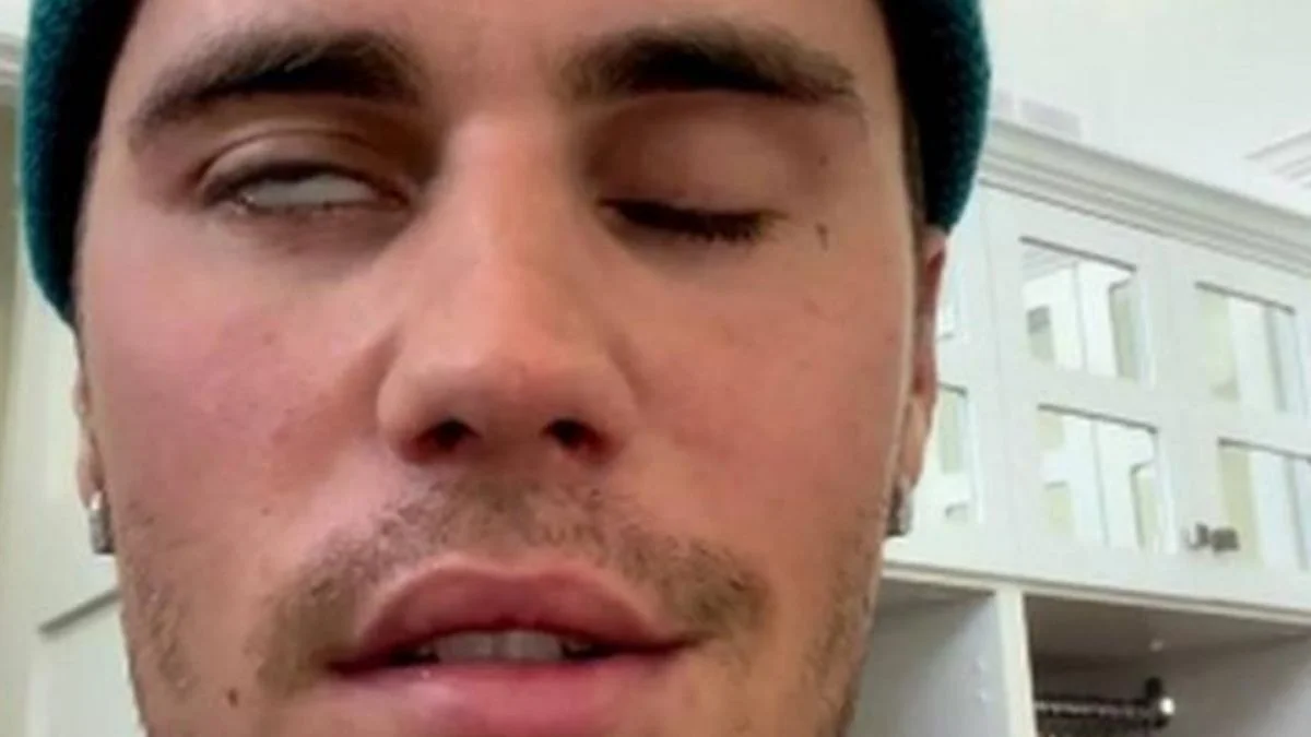 Justin Bieber yüz felci geçirdi