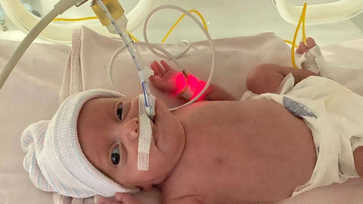 540 gramlık parmak bebek, kök hücre ile hayata tutundu