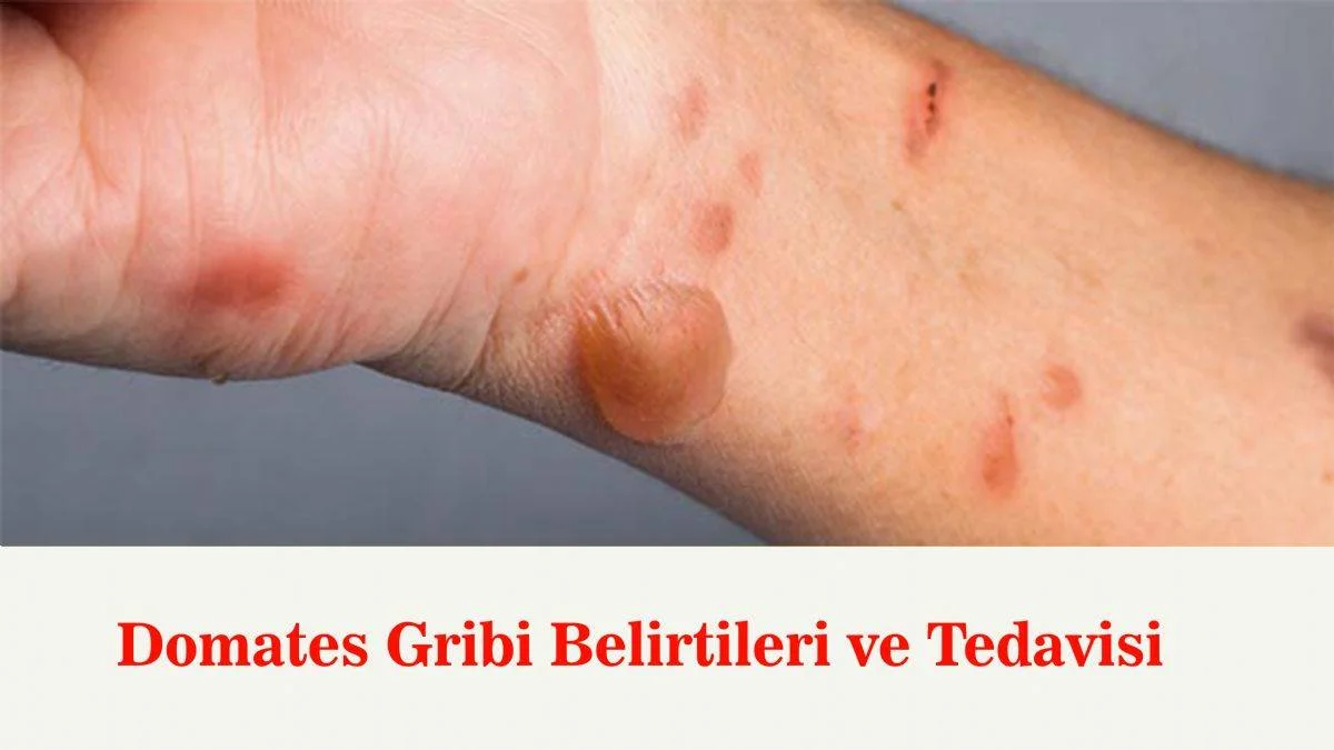 Domates gribi nedir, semptomları nelerdir? Domates gribi nasıl bulaşır? Domates gribi ölümcül mü?