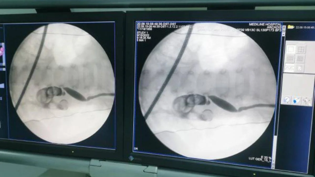 13 aylık bebeğin böbreğinden 5 santimetrelik taş çıkarıldı