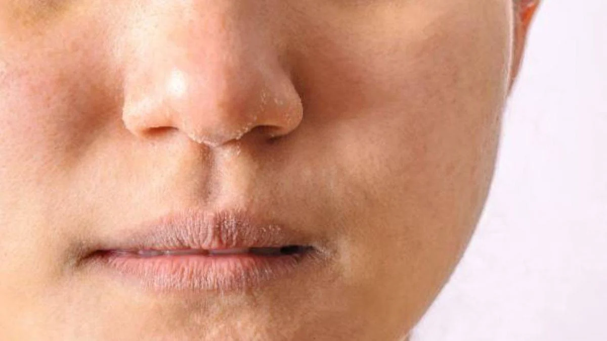 Cilt kuruluğu neden olur? Kuruluk hangi vitamin eksikliğinden olur? El, yüz ve dudakların kurumasının nedenleri