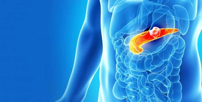 Pankreas Kanseri Nedir, Neden Olur? Pankreas Kanseri Risk Faktörü Nedir?