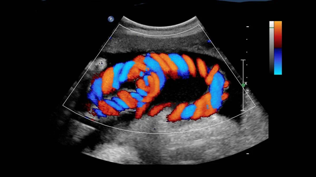 Renkli Doppler