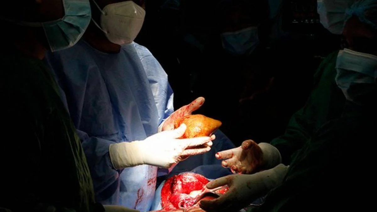 Dünyanın en büyük böbrek taşı! Tam 801 gram