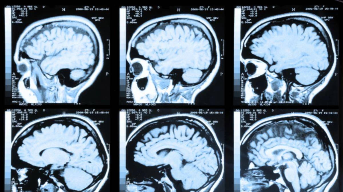 En genç Alzheimer vakası teşhis edildi