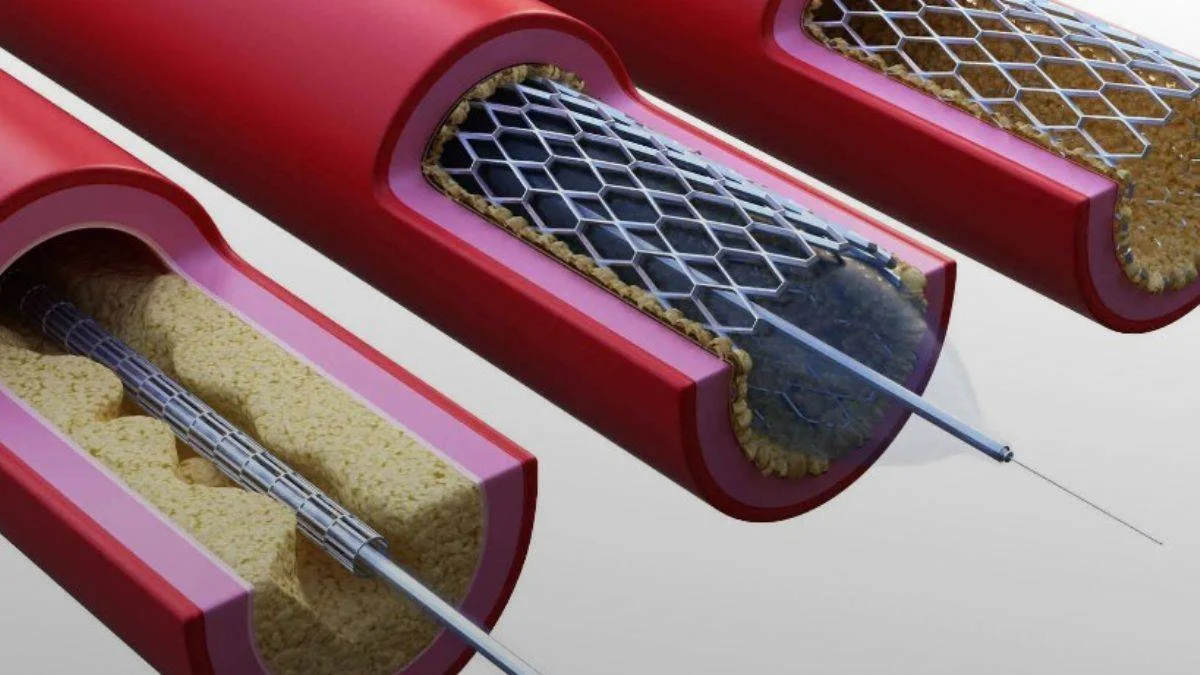 Kalp Sağlığınızı Koruyun: Stent Tedavisi ile Damar Sağlığınızı Güvence Altına Alın