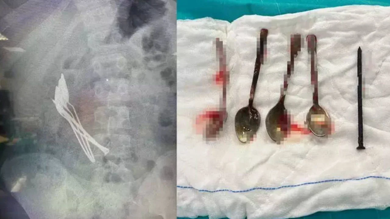 Çocuğun midesinden 4 kaşık ve 1 çivi çıkarıldı
