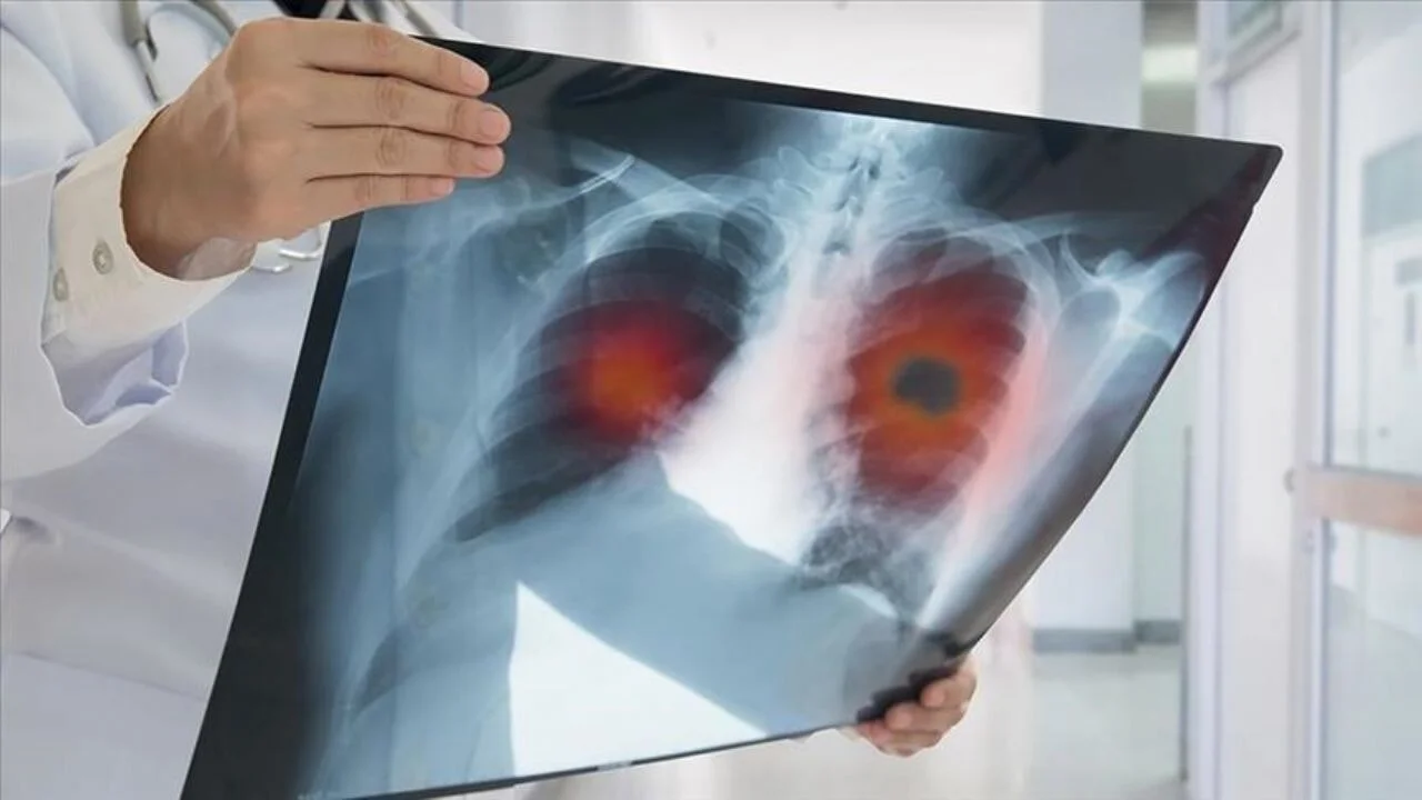 Hiç sigara içmeyenlerde akciğer kanser vakaları artıyor
